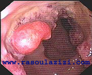 تصوير گرفته شده با کولونوسکوپي از تومور سرطاني داخل روده بزرگ